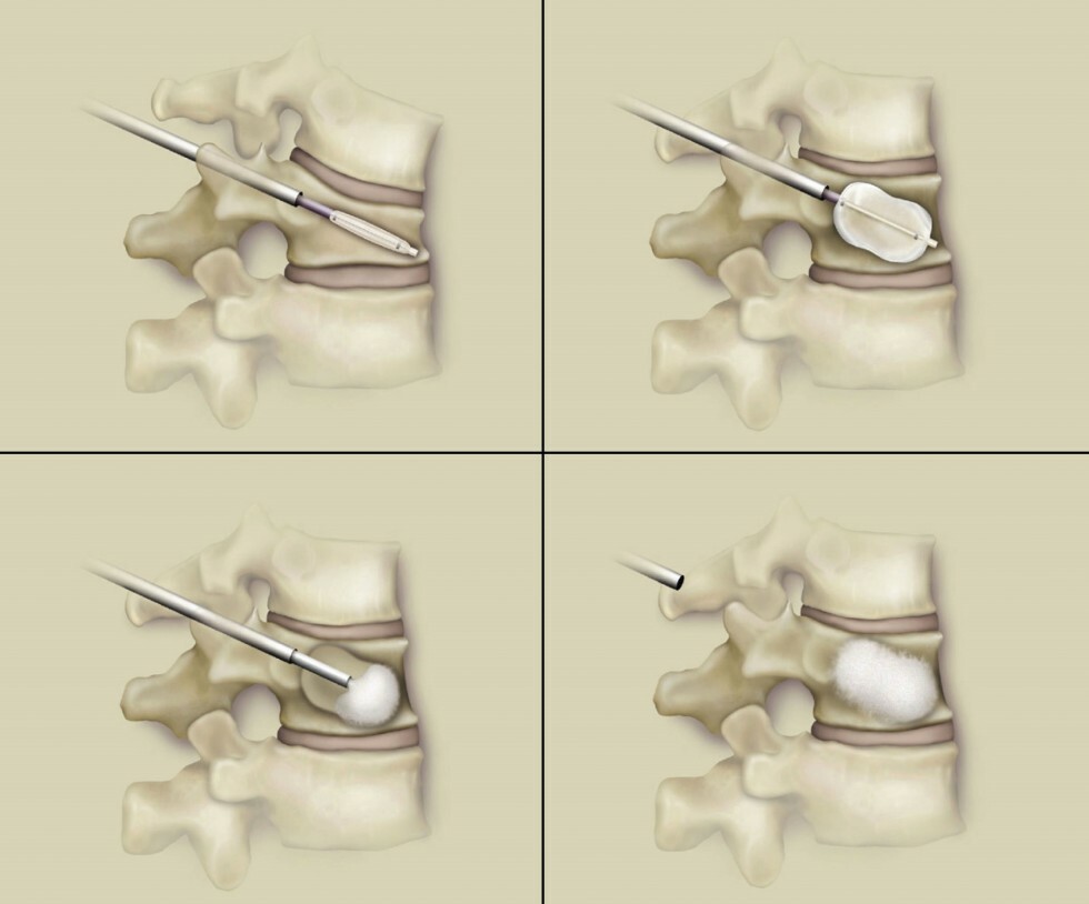 collage of kyphoplasty procedure